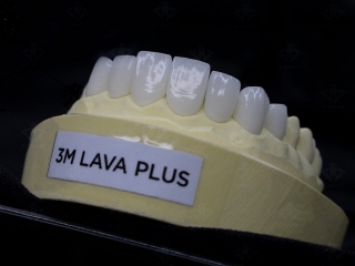 Răng sứ lava
